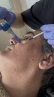 Pepelu Martínez apuesta por el Beauty Booster con Dermapen en Clínica Dorsia Sevilla Este - Gastronomía y Moda